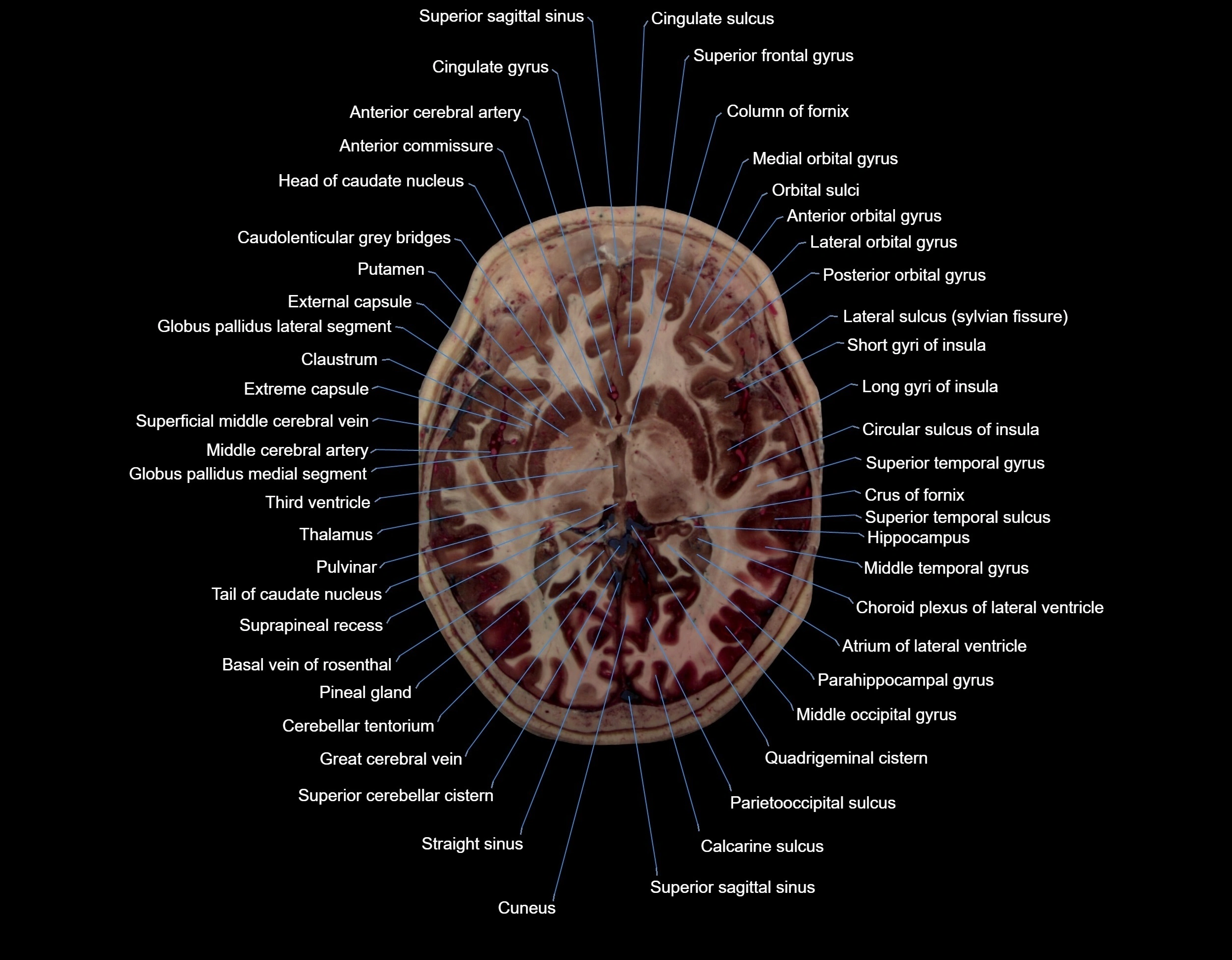 MRI Brain axial cross sectional radiology anatomy 3T image  -img-000041.webp